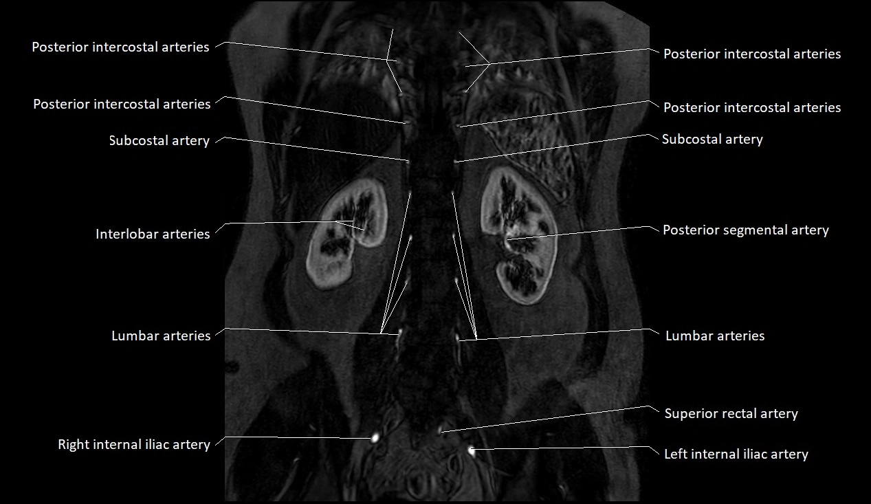 MRA Abdomen coronal anatomy image 44.webp